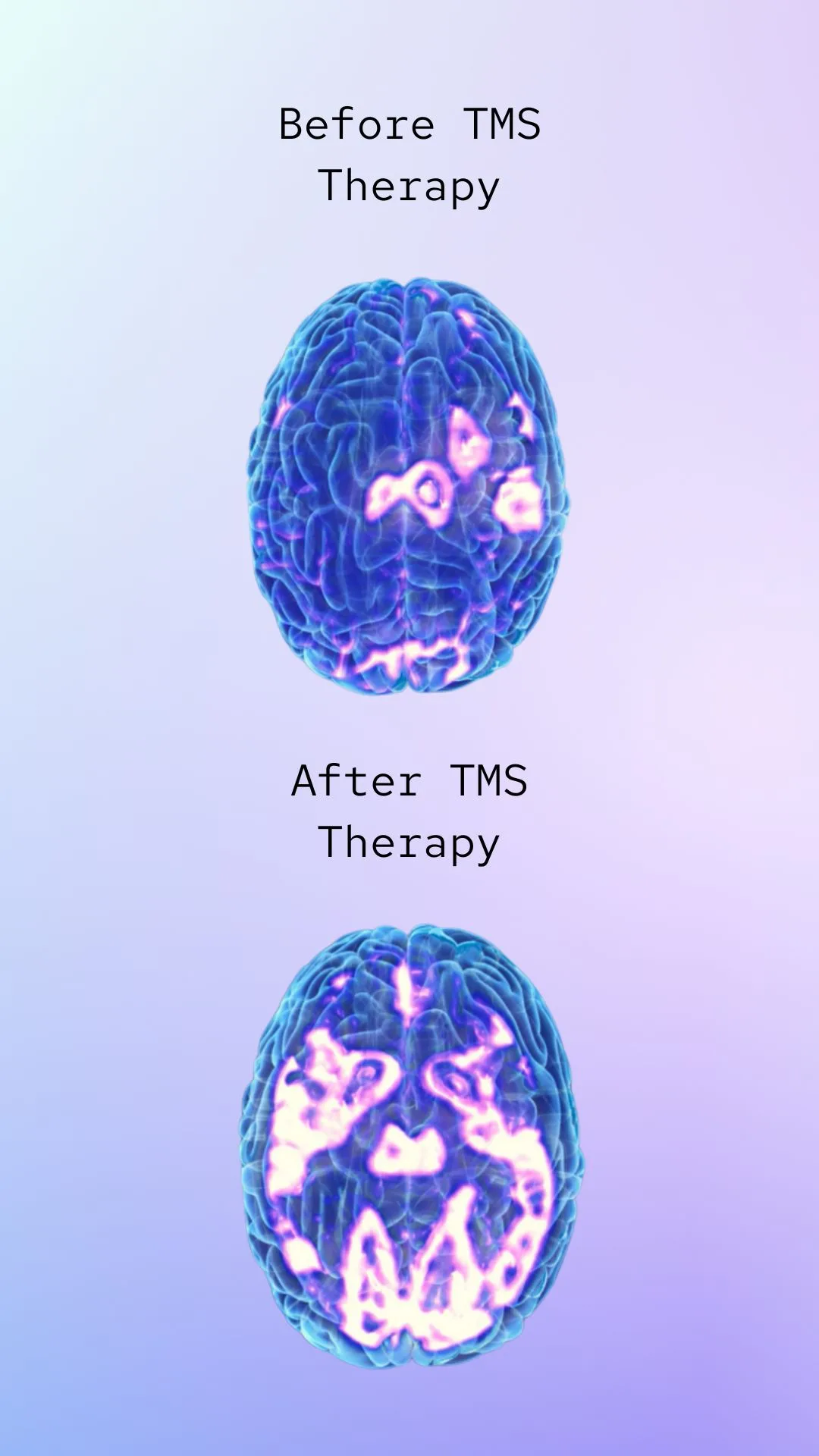 the brain before and after TMS therapy depression treatment los angeles ca